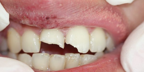 broken tooth broken tooth