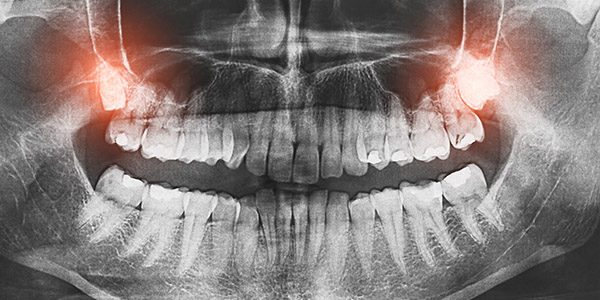 emergency wisdom tooth wisdom pain tooth