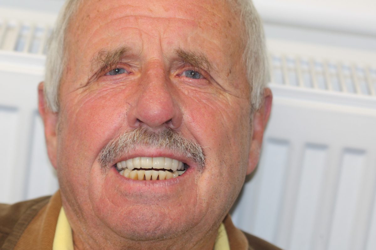 full smile after implant treatment dental implants herts dental