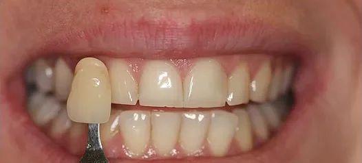 Teeth Whitening