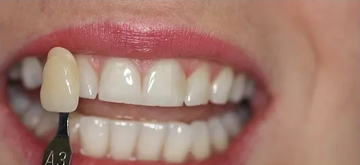 Teeth Whitening