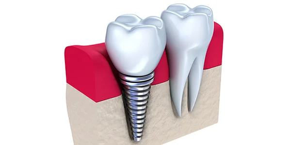 Dental implant Dental implant